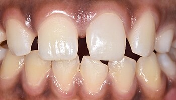 Child’s set of teeth one month after treatment