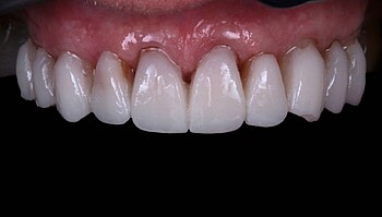 Fila de dientes después de 12 meses con LuxaCrown