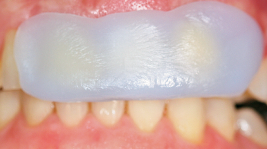 LuxaForm | Impression-taking for fabricating temporaries | Quick impression-taking with zero mixing Soft tablet placed on teeth