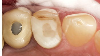 Fila de dientes defectuosa