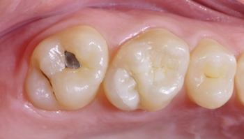 Fila de dientes antes del tratamiento