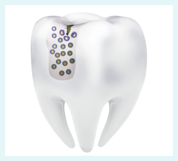 Tooth model with micelles