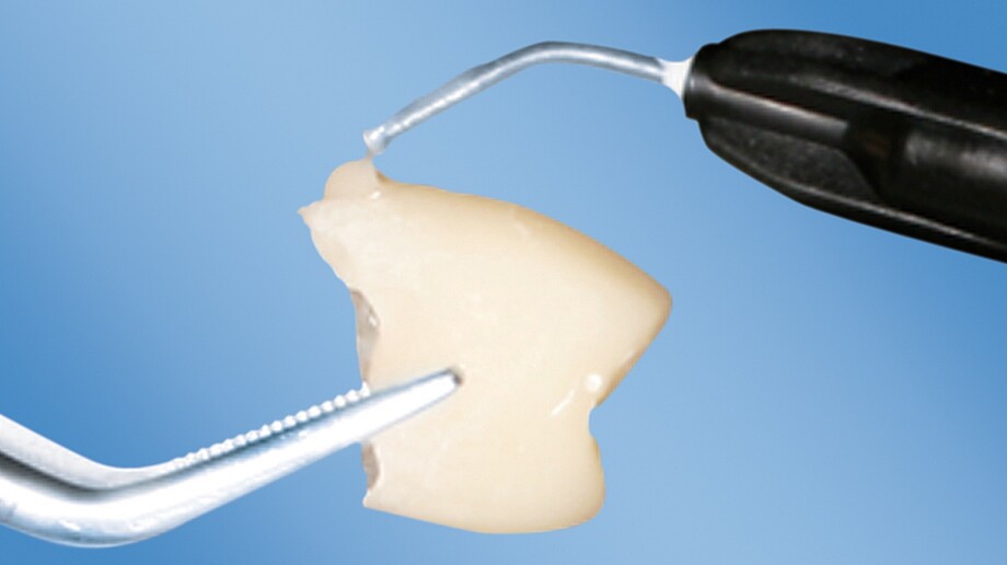 LuxaFlow Star | Composite | Aesthetic temporary restoration repairs, small fillings and underfillings Temporary repair with Luer-Lock Tip