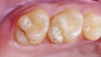 Fila de dientes después del tratamiento