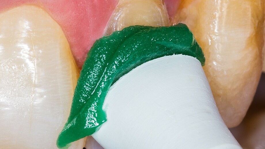 Flairesse Paste | Prophylaxis paste | No spattering Paste on polishing cup