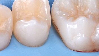 Superficie dental lisa