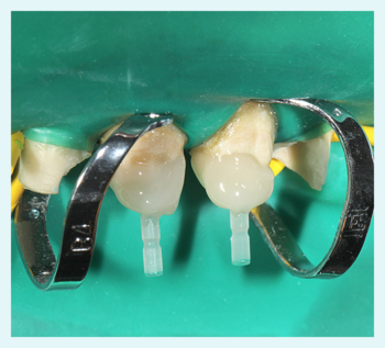 Prepared teeth for core build-up