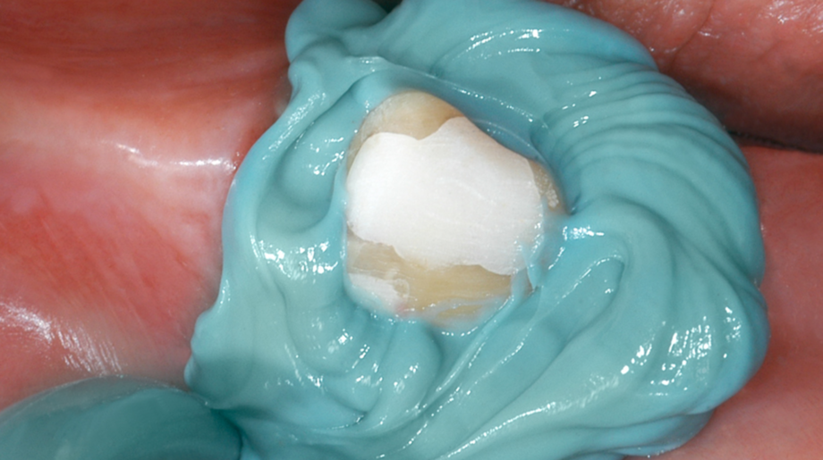 Honigum Mono | Single-phase impression | High precision and stability Application of Honigum Mono onto the prepared tooth