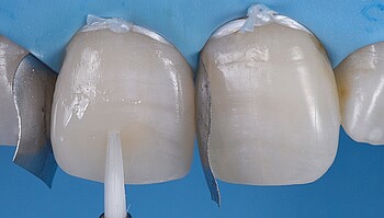 Mass is applied to the tooth