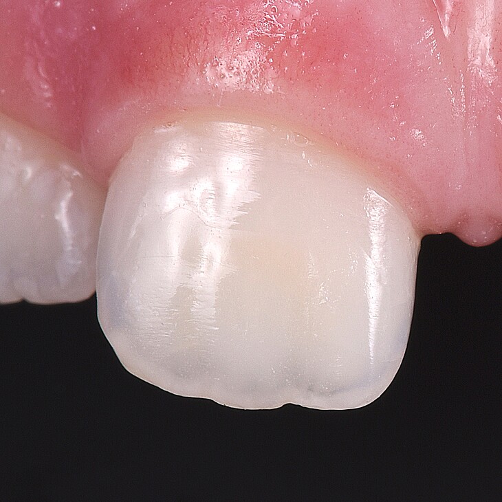 MIH affected tooth after treatment