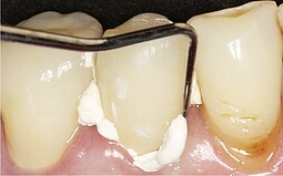 Removing the excess cement from the tooth with a probe