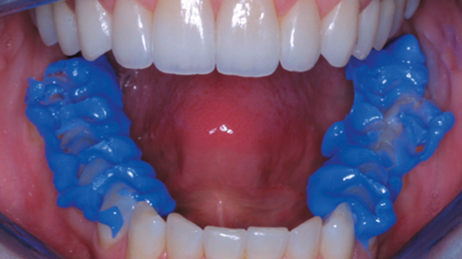 LuxaBite | Bite registration material | Hard and millable LuxaBite applied to the row of teeth
