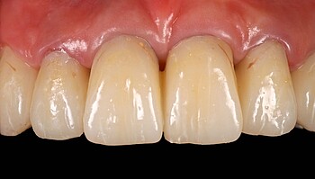 Dientes después de 3,5 años de uso de LuxaCrown