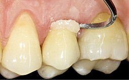 Aplicación del material sobre el diente
