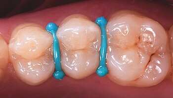 Material entre los dientes