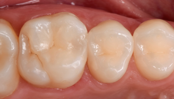 Ecosite Bulk Fill | Composite | Extremely safe, simple and effective View of the tooth