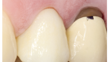 Defective row of teeth