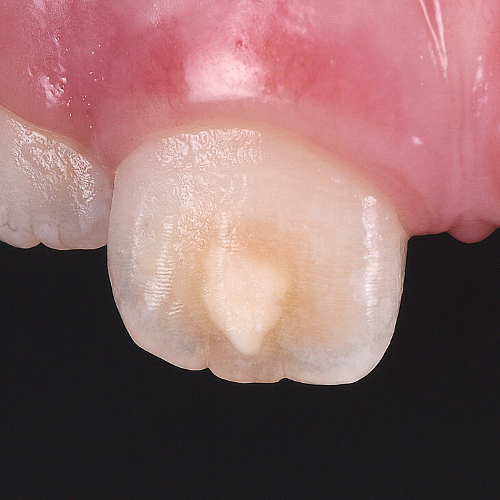 MIH affected tooth before treatment