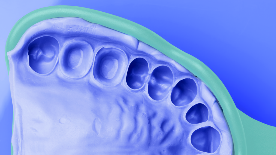 Silagum Putty | Crown and bridge impressions | Excellent stability First impression; mass in the tray