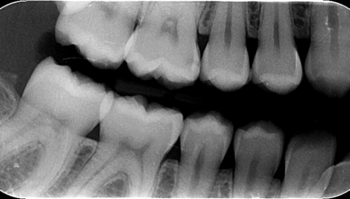 Ecosite Bulk Fill | Composite | Extremely safe, simple and effective X-ray image