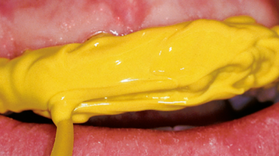 Yellow mass on teeth, does not drip