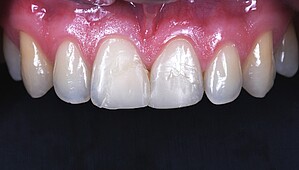 Anterior teeth with old filling before treatment