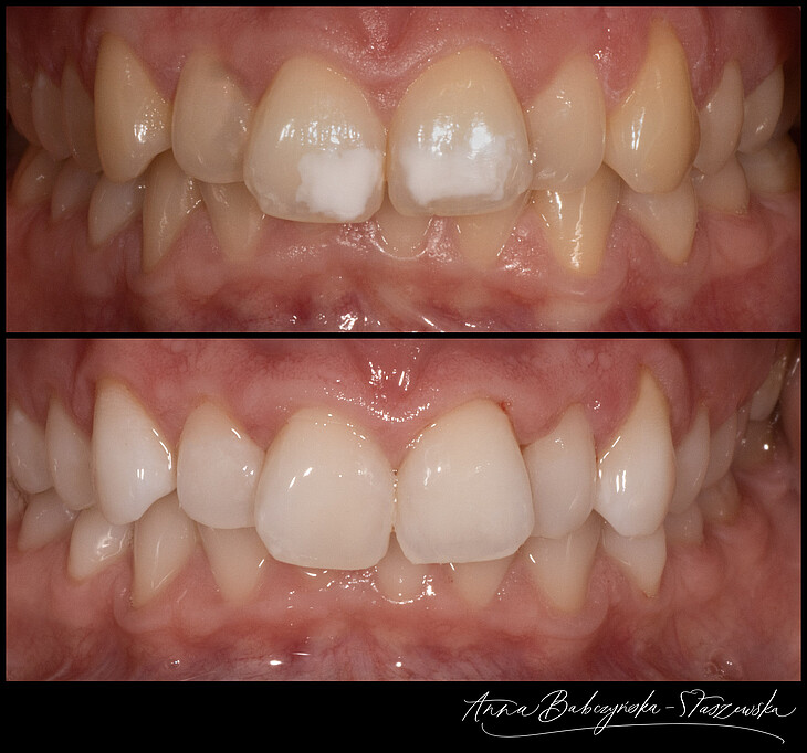 Before and after the treatment with bleaching and Icon Vestibular