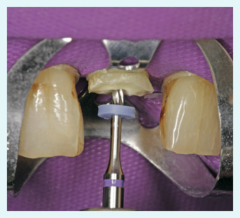 Preparing the root canal with the drill