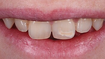 White spots on the incisors