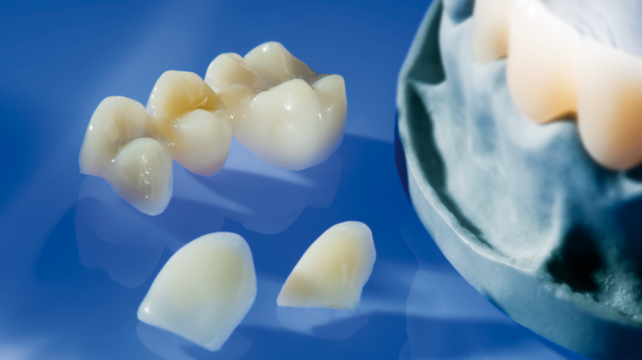 Luxatemp Glaze & Bond | One-component varnish | High gloss with zero polish and abrasion resistance Various temporaries