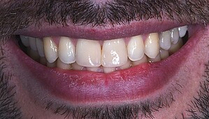 Anterior teeth after restoration
