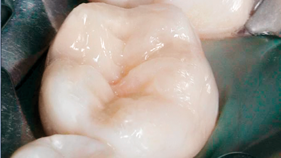 EcuSphere Composite System | Filling system | Durable aesthetics, long-lasting and natural Figure: tooth filled with EcuSphere