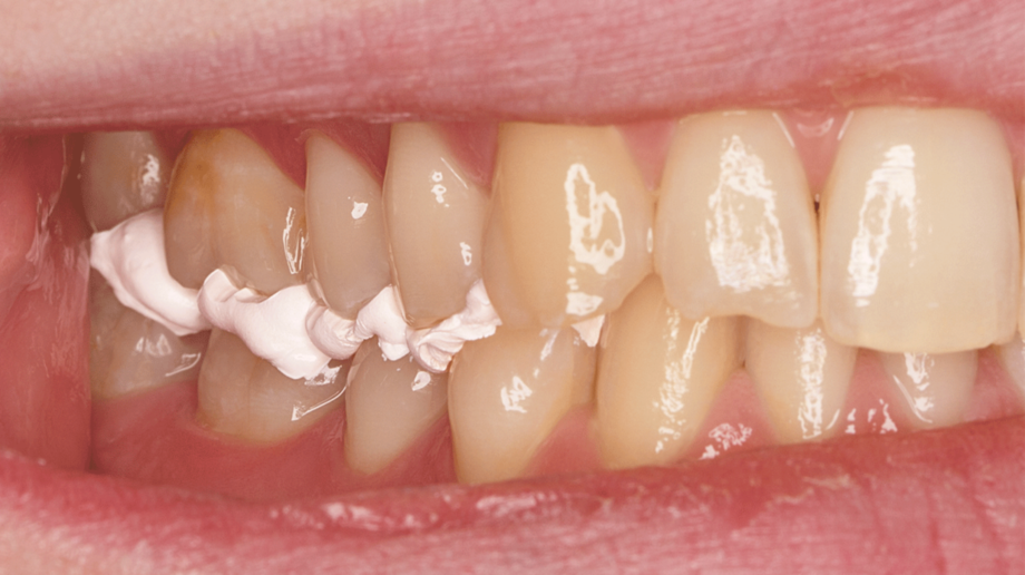 O-Bite Scan | Bite registration | Extremely high final hardness and easy to use Mass between upper and lower jaw