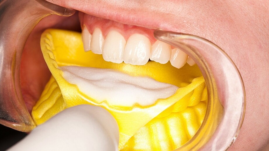 Flairesse | Prophylaxis foam | Strengthening the enamel Flairesse Foam on tray in mouth