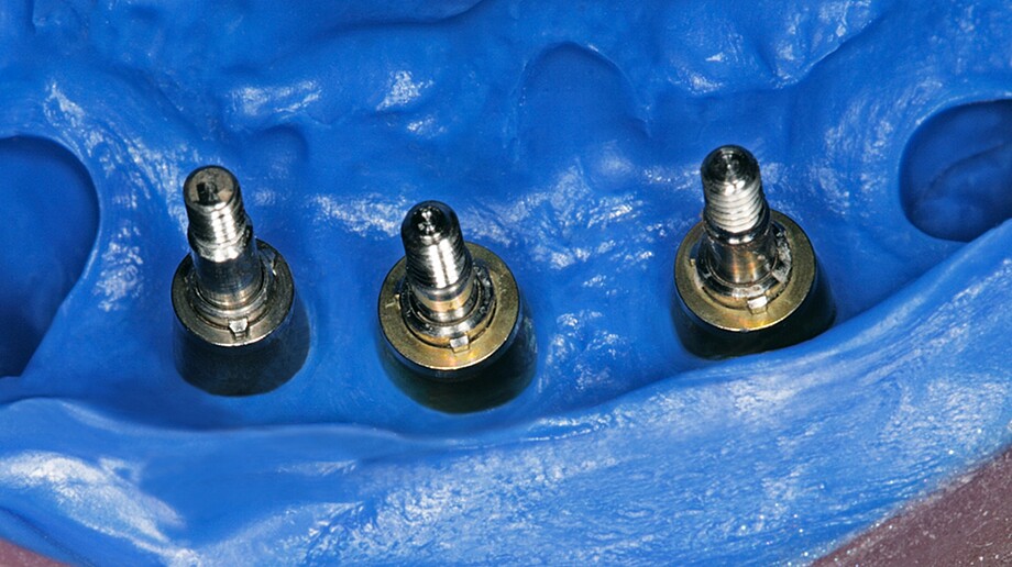 Honigum Pro Heavy | Pre-impression material | High final hardness Fixation of the impression posts