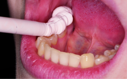 Aplicación del material en la boca