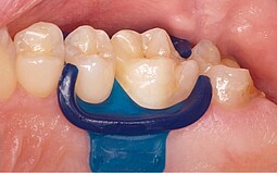 Silicona azul entre dos dientes