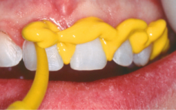 Coating the teeth with Honigum Light