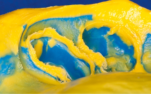 Honigum Pro Light High Precision Correction Impression Material